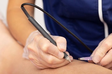 Electrolysis treatment for men in Osaka